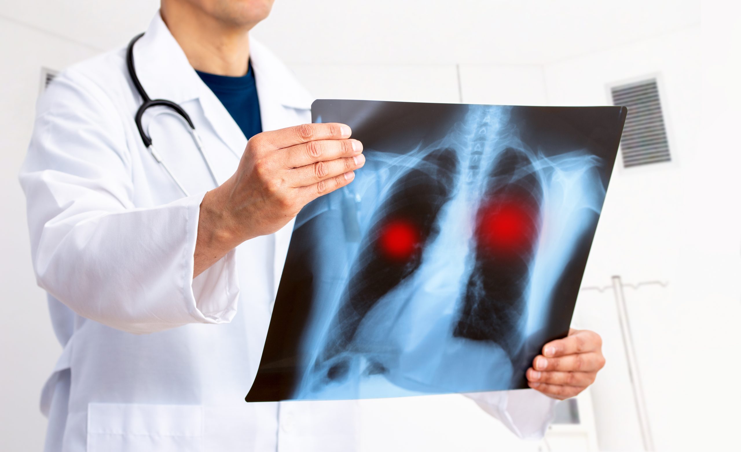 Lung,Cancer,Or,Pneumonia.,Doctor,Check,Up,X-ray,Image,Have