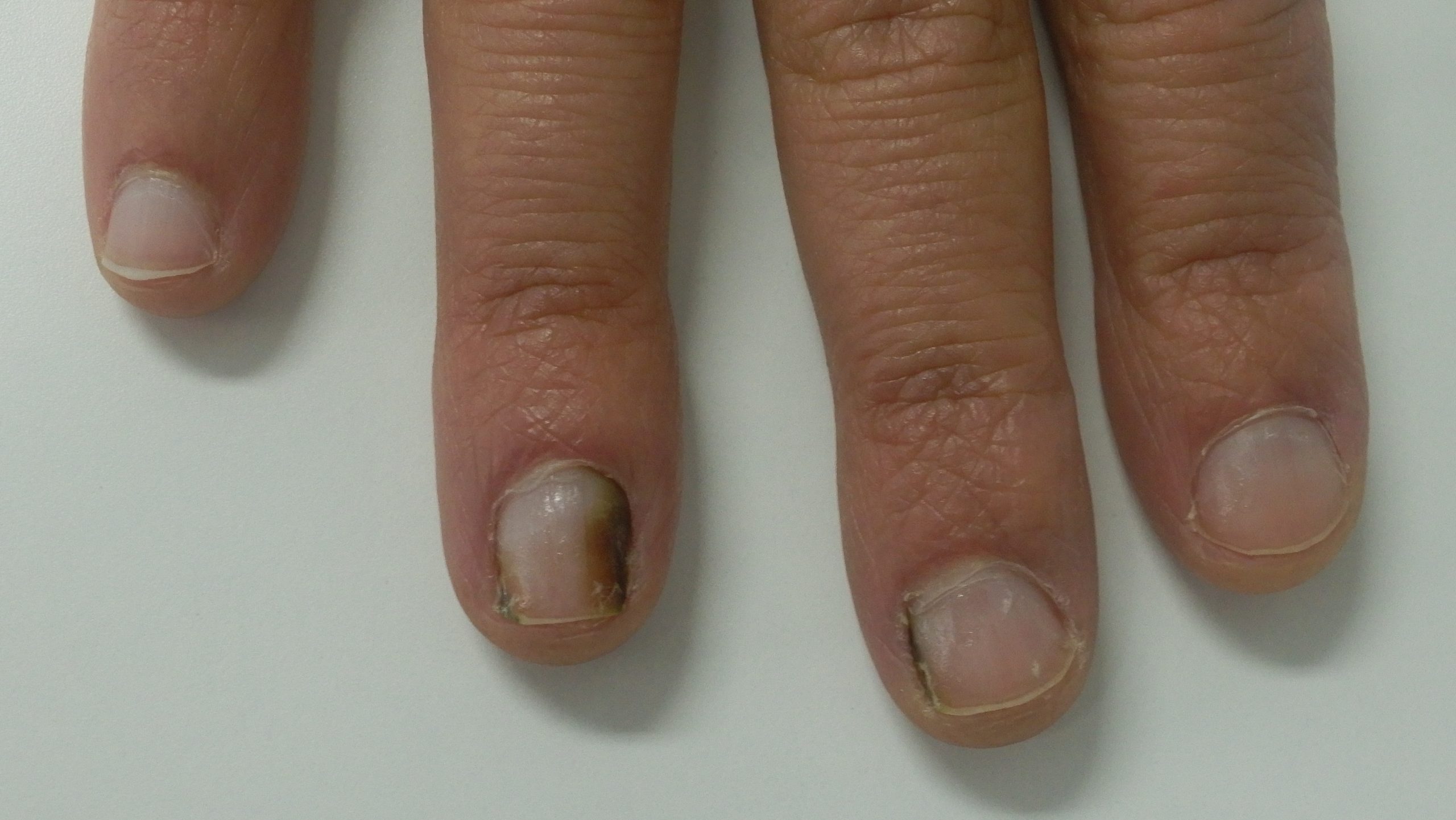 Nail Discolouration