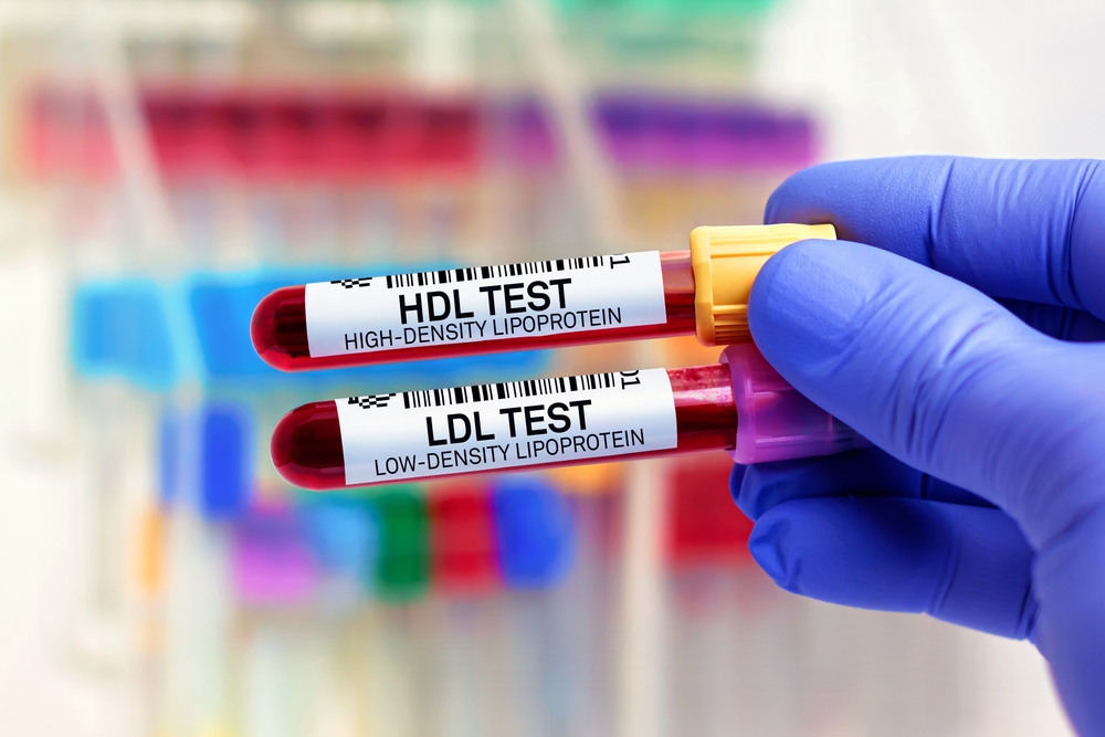 Blood,Samples,Of,Patient,For,High,Density,Lipoprotein,Hdl,And