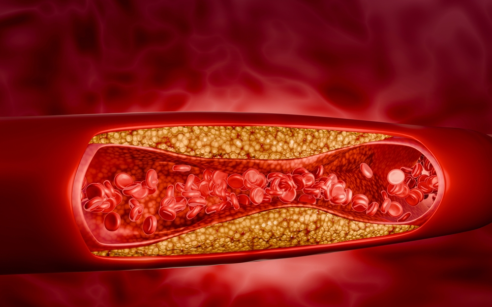 Blocked,Artery,Filled,With,Accumulation,Of,Fat,,Cholesterol,Plaques,,Blood
