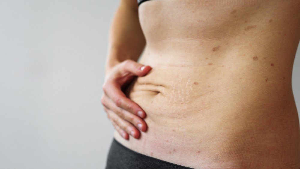CT Health and cosmetic issues related to rapid weight loss