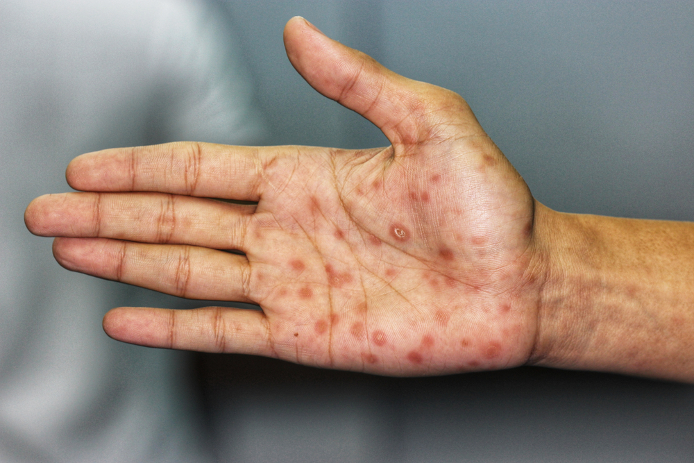 Secondary,Stage,Syphilis,Sores,(lesions),On,The,Palms,Of,The
