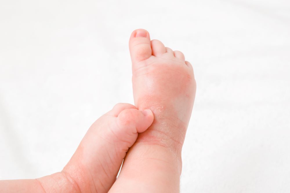 Cows Milk Allergy Smaller Size