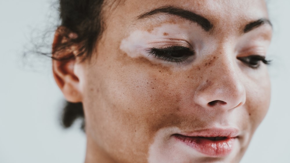 Article feature image - vitiligo