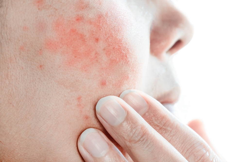 More,Red,Rashes,Appear,On,Women's,Faces,Due,To,Cosmetic