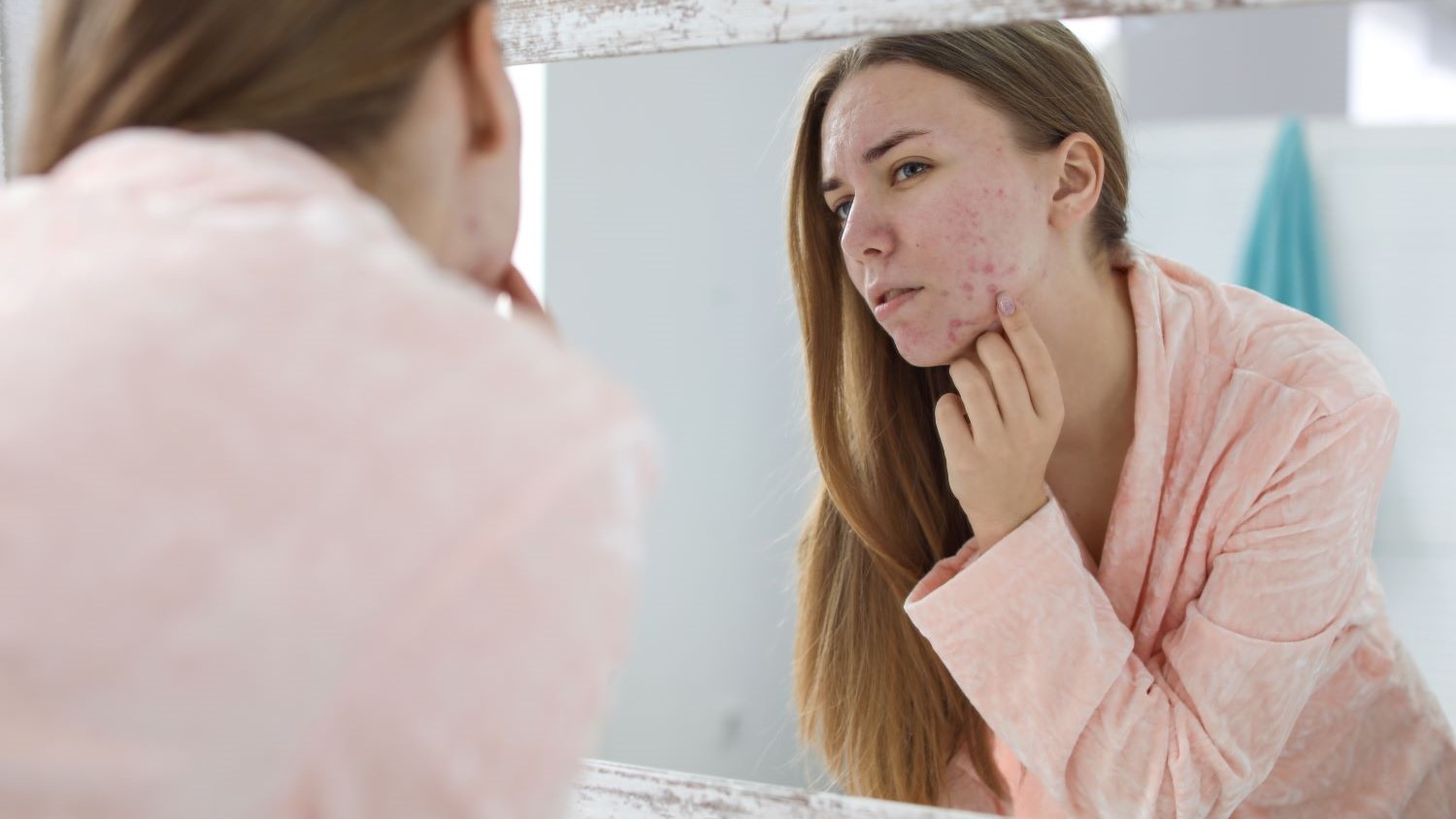 Article feature image - Acne update
