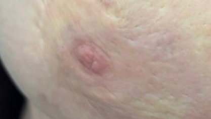 Breast quiz image 1 - 16x9 - angiosarcoma