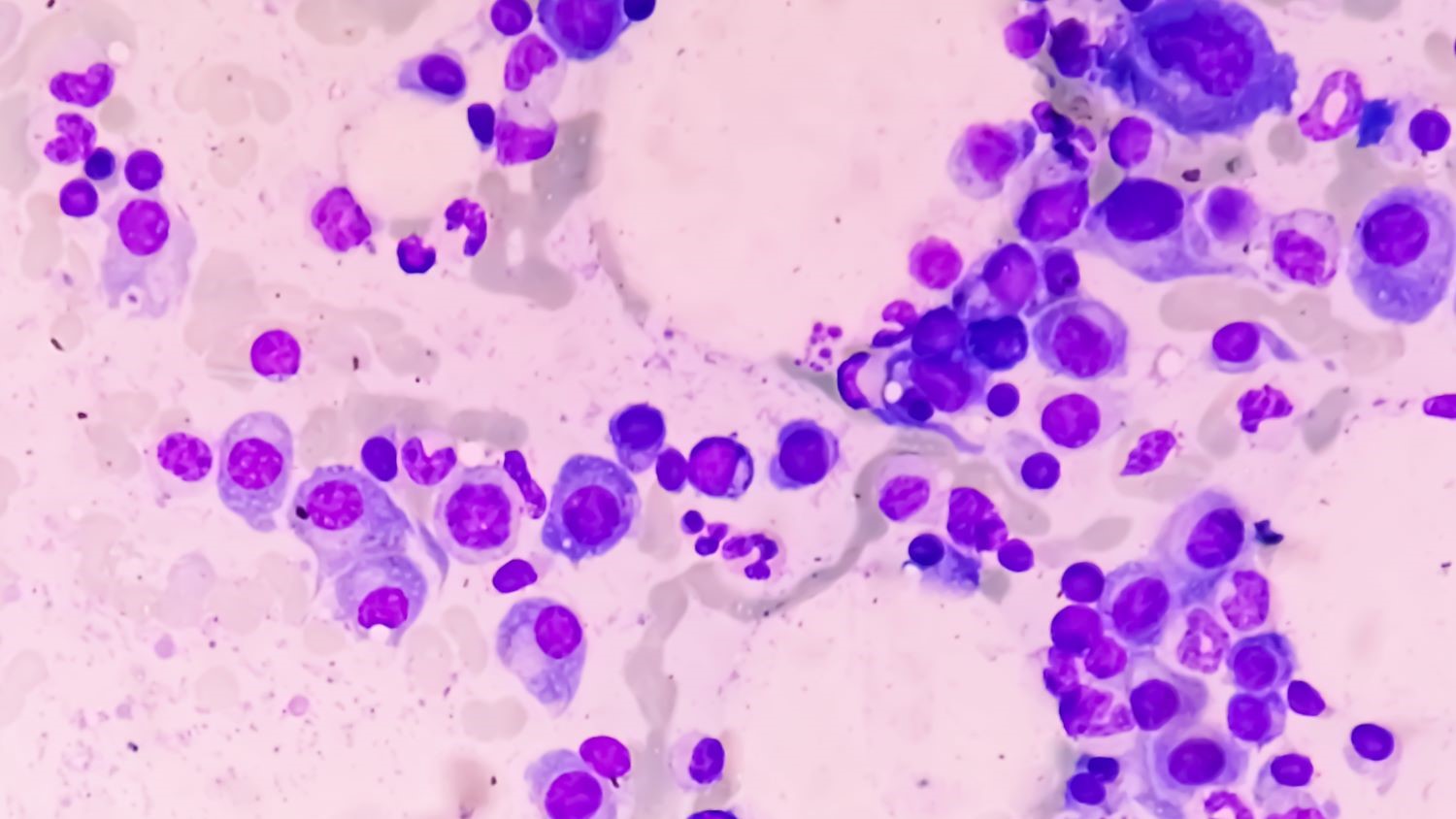 CT Feature image - multiple myeloma