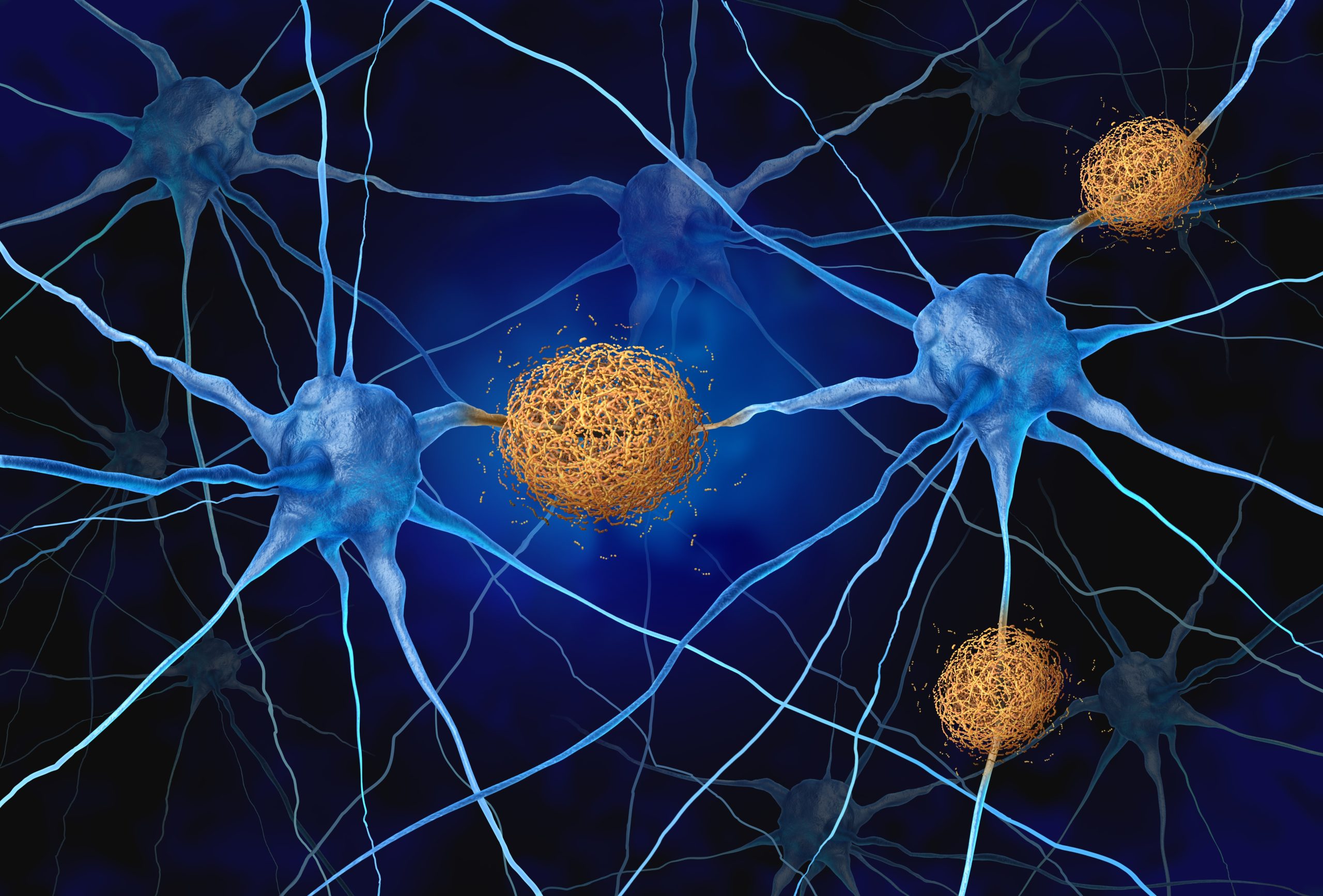 Amyloid,Plaques,Concept,As,Abnormal,Clusters,Of,Protein,Fragments,That